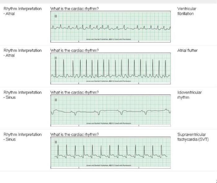 Relias basic dysrhythmia test a answers